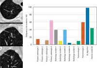AI Predicts Lung Cancer Risk