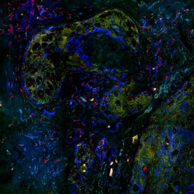 Cancer Cells within Tumors