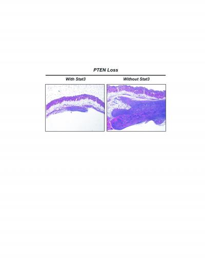 Stat3 as Tumor Suppressor
