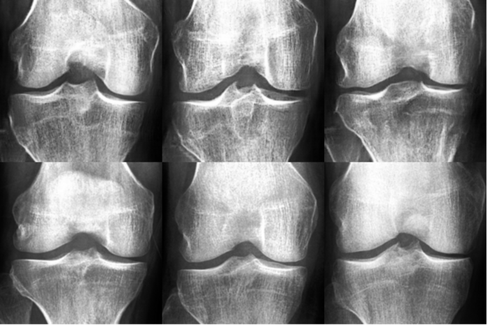 Ai Generated X Ray Images Fooled Medical Expe Eurekalert