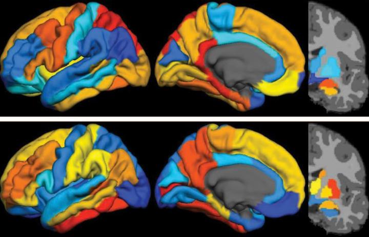 PET Scans Reveal that Tau Predicts Alzheimer's Disease Progression