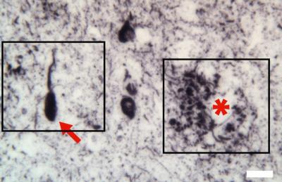 3 Brain Diseases Linked by Toxic Form of Same Neural Protein