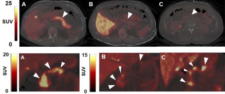 PET/CT images of Pancreas