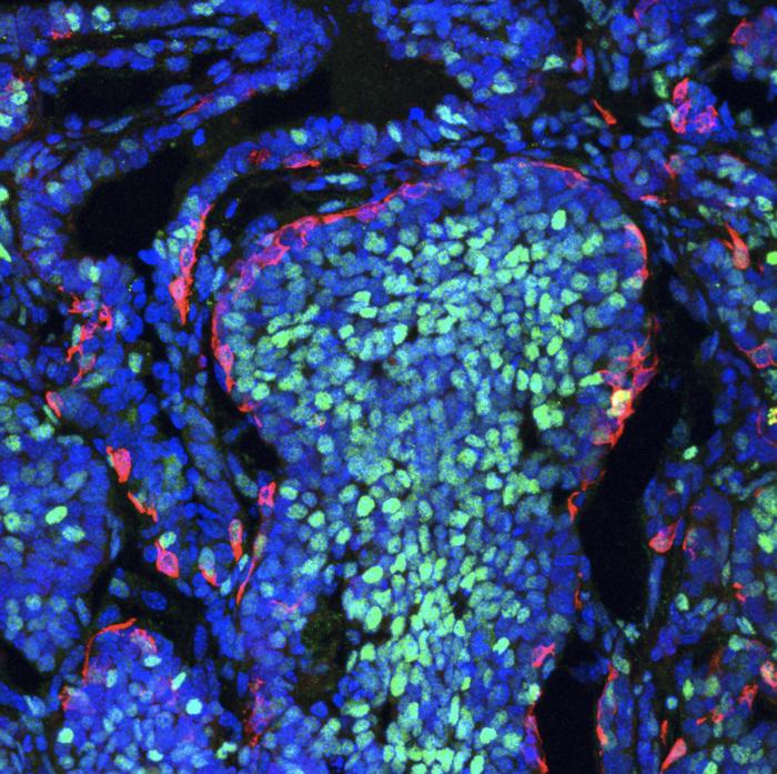 Study opens new avenues to target highly aggressive therapy-resistant tumors