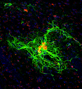 Astrocytes and amyloid plaques