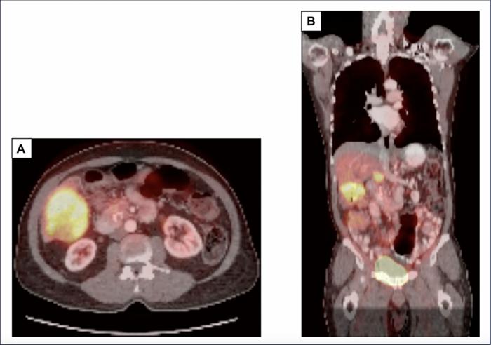 A case of adenosquamous pancreatic cancer with a KRAS G12C mutation with an exceptional response to immunotherapy