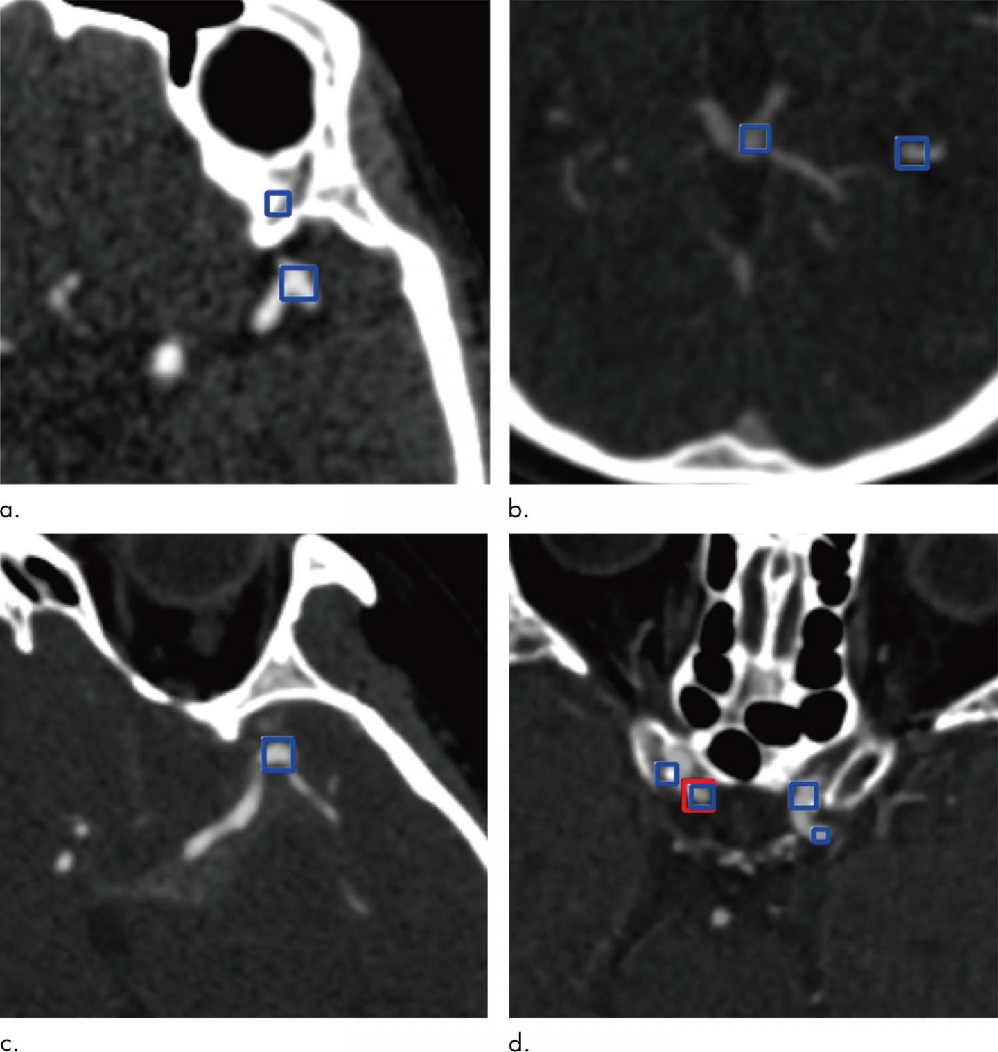 AI Helps Detect Brain Aneurysms on CT Angiography