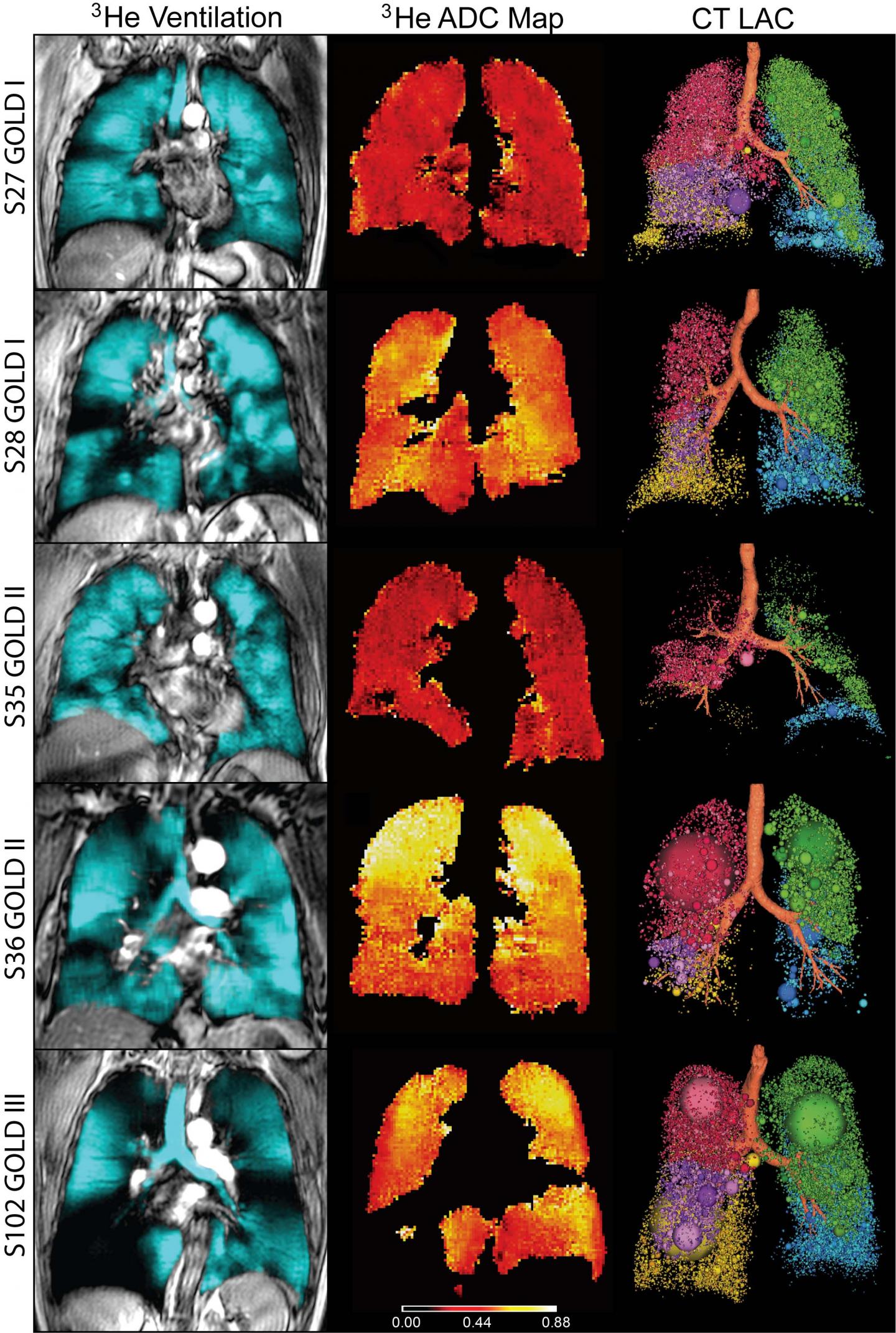 Representative Patients with COPD