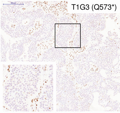Bladder tumour sample containing mutations in the STAG2 gene. / CNIO