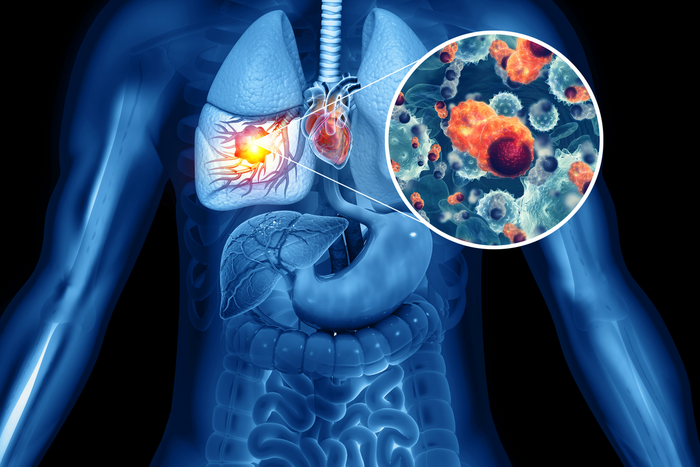 Understanding protein variants could improve the diagnosis and treatment of lung cancer