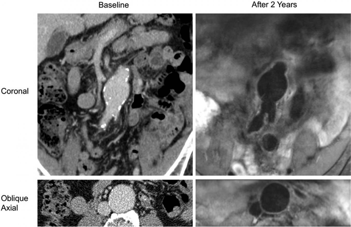 Presence of Blood Clot Associated with Rapid Aortic Aneurysm Growth (3 of 3)