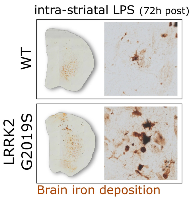 parkinson’s disease mutation misdirects iron in the brain