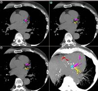 CT Shows Enlarged Aortas in Former Pro Football Players (2 of 3)