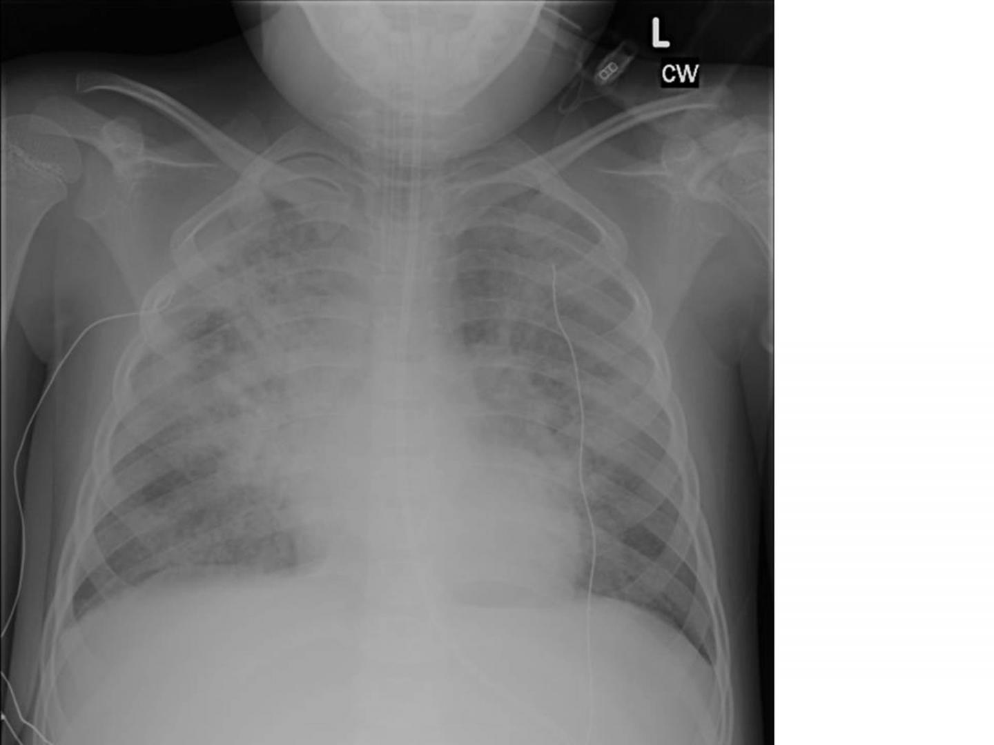 respiratory distress syndrome x ray