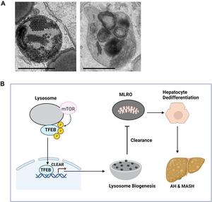 TFEB and MLRO in hepatocyte dedifferentiation and alcohol-associated hepatitis (AH) and metabolic dysfunction-associated steatohepatitis (MASH).