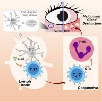 Neutrophils Cause Obstruction of Eyelid Sebaceous Glands in Inflammatory Eye Disease in Mice
