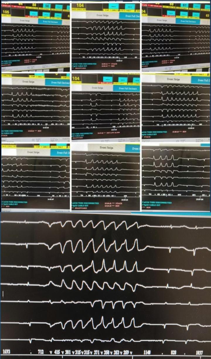 First Known Case of a Potentially Deadly Heart Rhythm Disturbance Induced by Chloroquine Therapy for