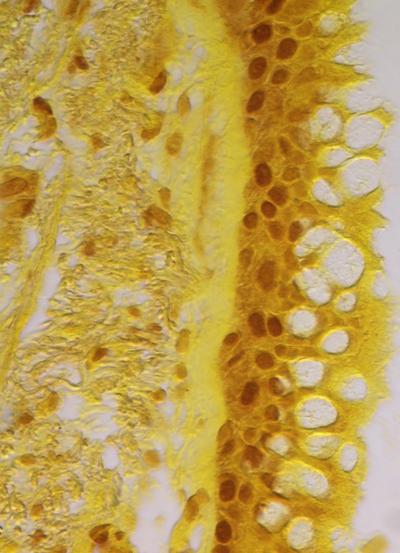Epithelial Cells of a COPD Patient
