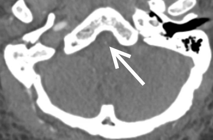 Diabetes, Hypertension May Increase Risk of COVID-19 Brain Complications
