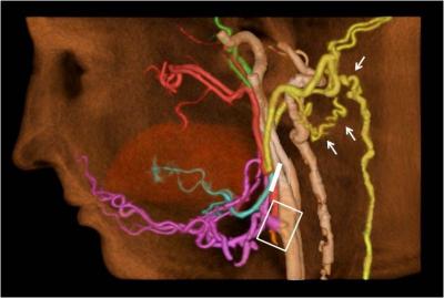 Donor's External Carotid Artery