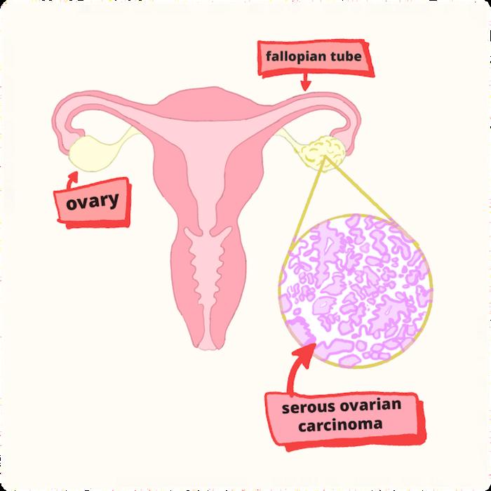Multi-omics analysis found a way to reduce ovarian tumor formation