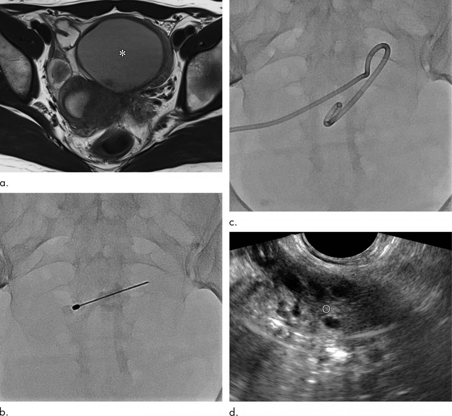Clinical Course of a 30-Year-Old Woman with Primary Ovarian Endometrioma Presenting with Lower Abdom