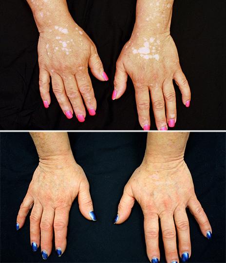 For Vitiligo Patient, Arthritis Drug Restores Skin Color