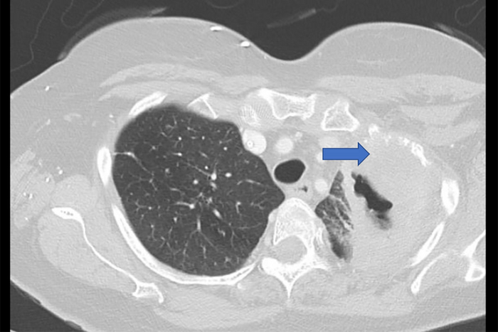 $5.3 million grant supports research into lung cancer recurrence