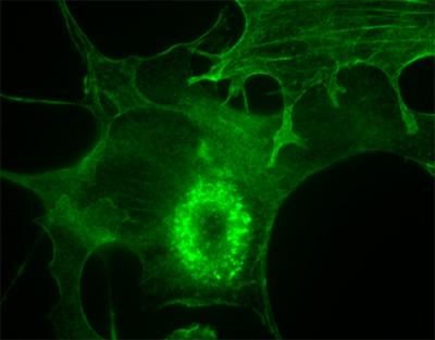 UNC Research Probes How Pancreatic Cancers Metastasize