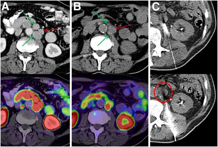 Intra-patient tumor heterogeneity makes tissue sampling of the most appropriate index lesion challenging.