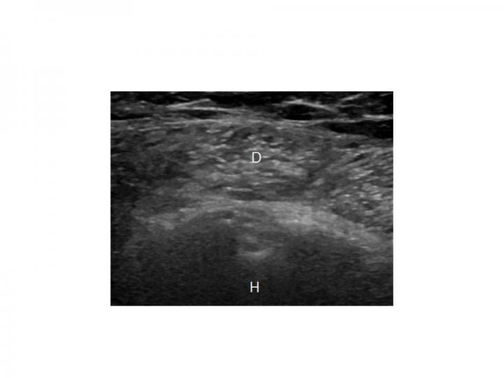 Image of a Deltoid Muscle in a Patient with Type 2 Diabetes