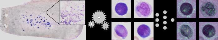 AI-based processing of bone-marrow smears to support leukaemia diagnosis.