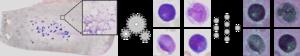 AI-based processing of bone-marrow smears to support leukaemia diagnosis.