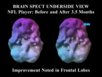 SPECT Brain Scan 2