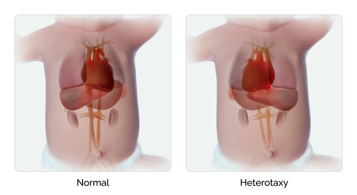 Heterotaxy