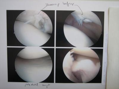 Damaged Knee Cartilage