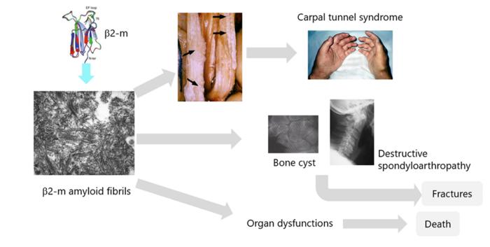 Figure 1. Pathophysiology of dialysis-related amyloidosis