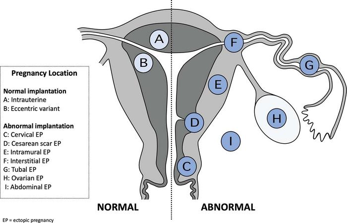 Specific normal and abnormal pregnancy location sites