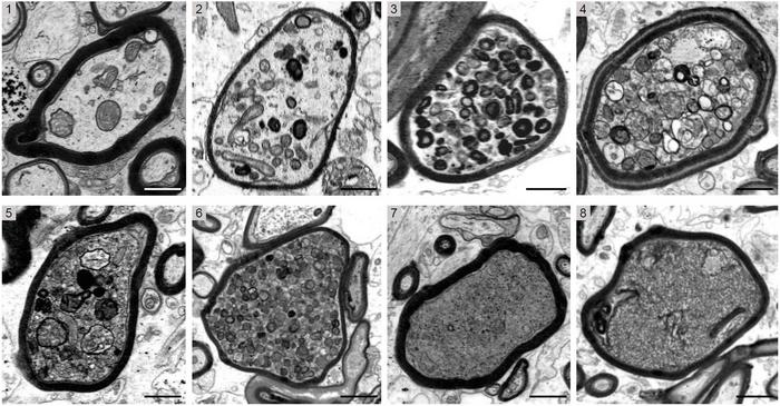 Cross-sectional electron micrographs of individual nerve fibers in MS brain biopsies