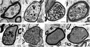 Cross-sectional electron micrographs of individual nerve fibers in MS brain biopsies