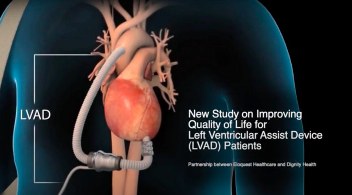 New Research from Dignity Health on Improving Quality of Life for LVAD Patients