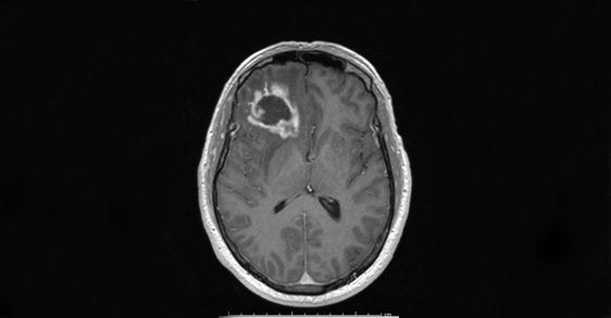 Glioblastoma Tumor