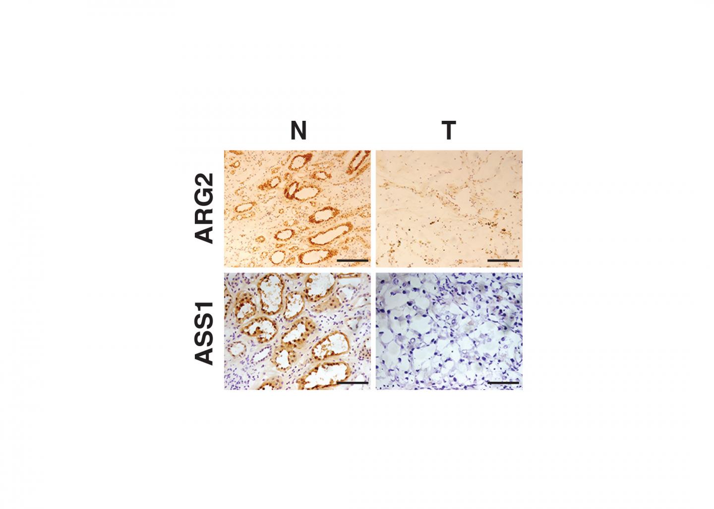 Metabolic Cancer