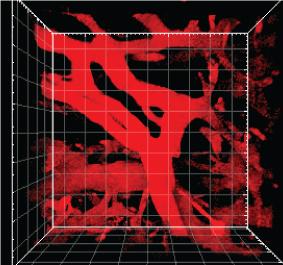 Blood Vessels around a Pancreatic Tumor Become Leakier in the Presence of Fasudil