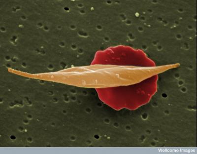 Sickle Cell Anemia