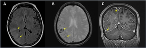 Large International Study Reveals Spectrum of COVID-19 Brain Complications
