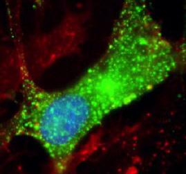 New Clues to Nodding Syndrome