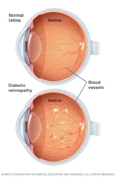 A Healthy Lifestyle for Cardiovascular Health also Promotes Good Eye Health