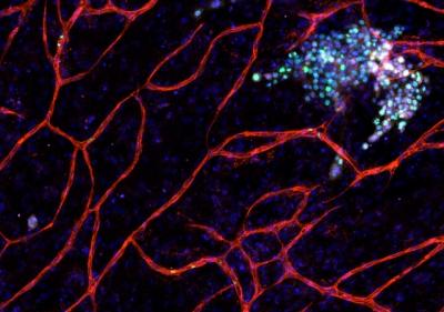 Dormant Cancer Cells Metastasizing