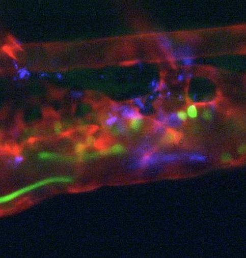 Aspirin to Fight An Expensive Global Killer Infection